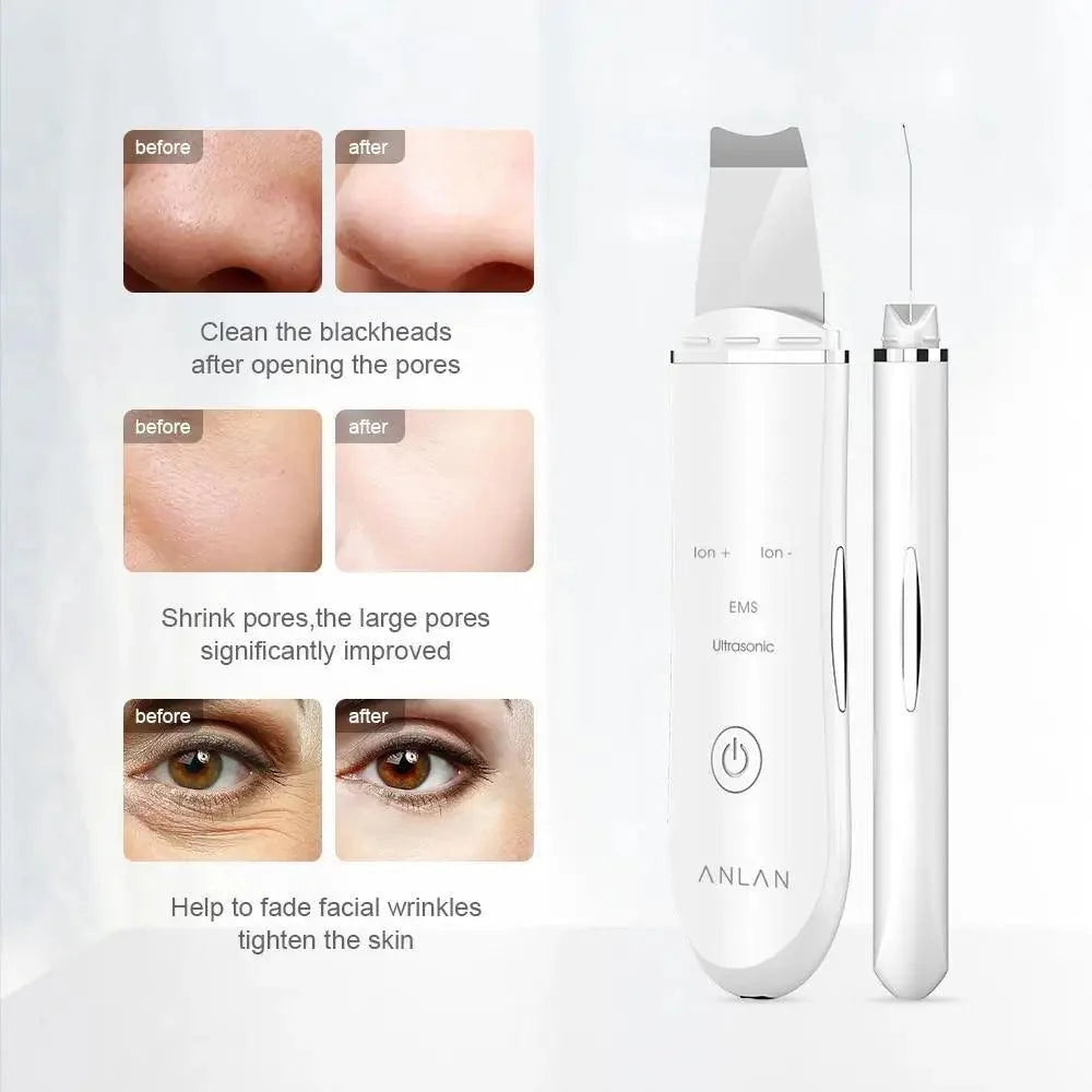 Ultrasonic Derma Skin Scrubber Pen for Face Cleansing Dead Skin Cleaner - Skin Care Tools Beauty Modern Tool