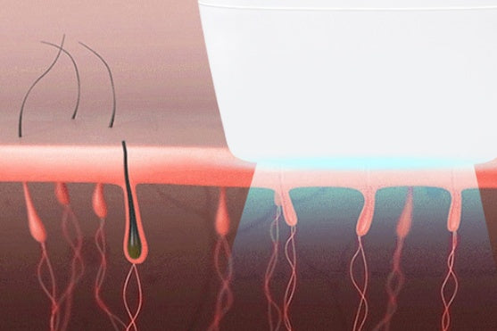 Laser Hair Removal Device